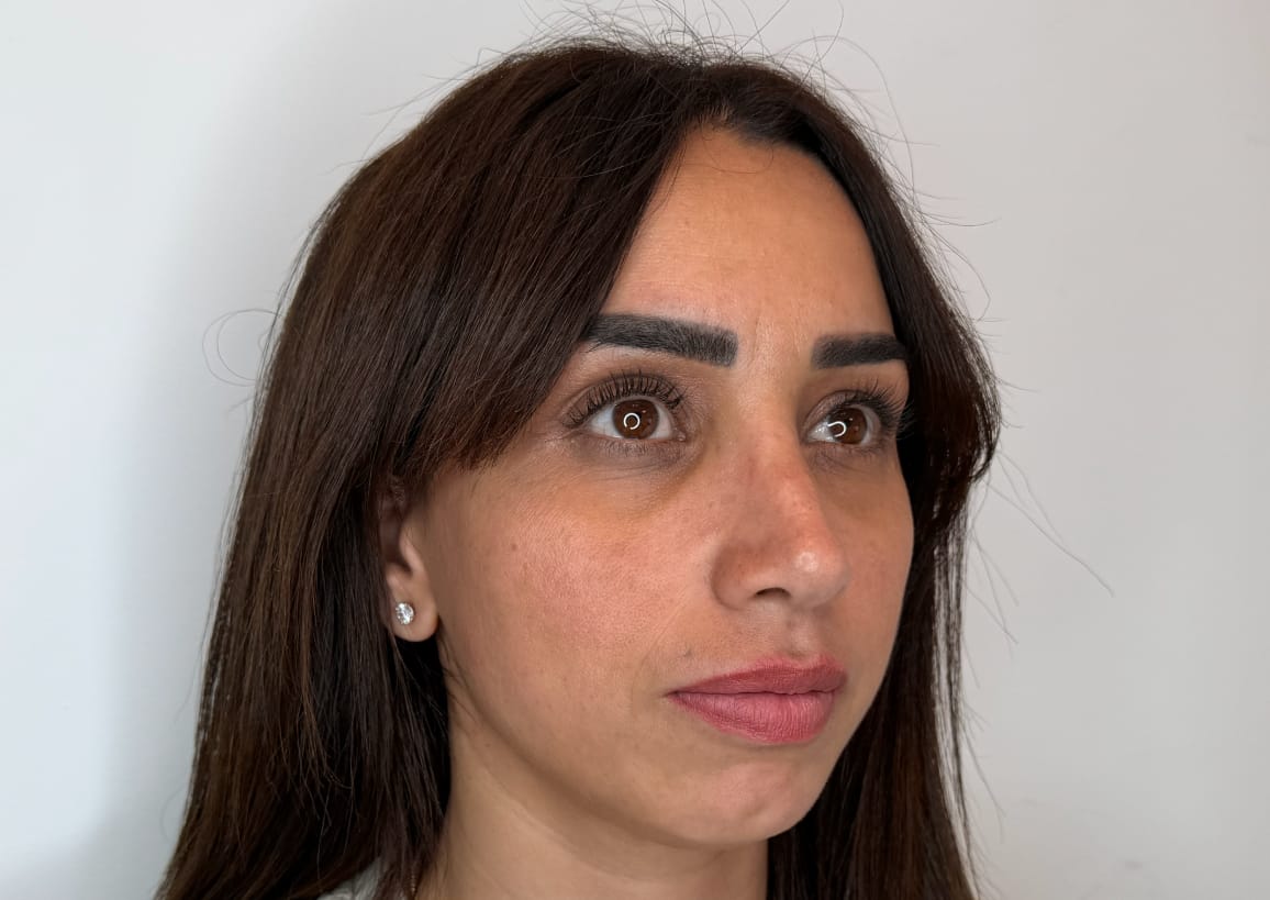 לפני טיפול פיסול פנים באריאל מדיקל